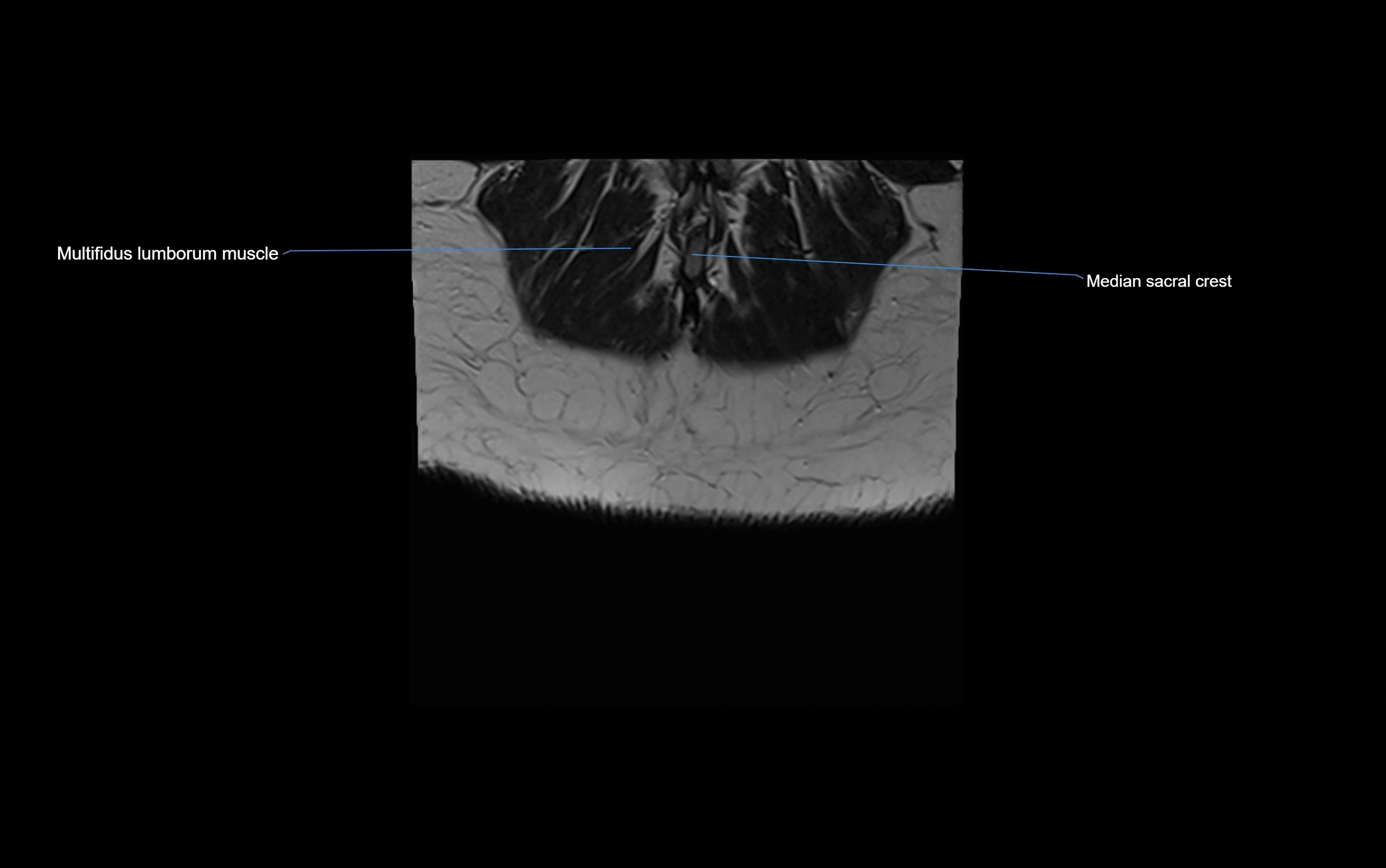 MRI sacroiliac joint coronal cross sectional anatomy  radiology  image-img-00001-00033.webp